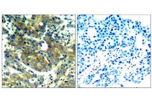 Immunohistochemical analysis of paraffin-embedded human breast carcinoma tissue, using p70 S6 Kinase (phospho-Ser411) antibody (E011269). (RPS6KB1 antibody  (pSer411))