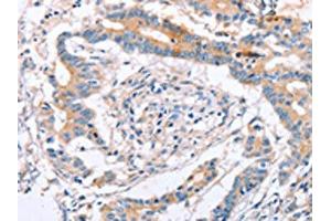 The image on the left is immunohistochemistry of paraffin-embedded Human colon cancer tissue using ABIN7129824(IGSF8 Antibody) at dilution 1/15, on the right is treated with fusion protein. (IGSF8 antibody)