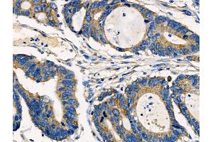 ABIN6261350 and ABIN6266893 at 1/100 staining Human colorectal cancer by IHC-P. (DOK3 antibody  (Internal Region))