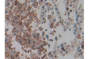 DAB staining on IHC-P; Samples: Human Lung cancer Tissue) (IL1A antibody  (AA 113-271))