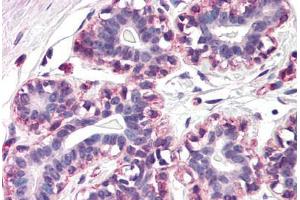 Human Breast (formalin-fixed, paraffin-embedded) stained with RAMP3 antibody ABIN290466 at 20 ug/ml followed by biotinylated goat anti-rabbit IgG secondary antibody ABIN481713, alkaline phosphatase-streptavidin and chromogen. (RAMP3 antibody  (N-Term))