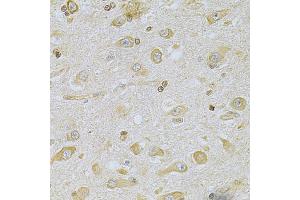 Immunohistochemistry of paraffin-embedded human brain cancer using CAMK1D Antibody (ABIN5975586) at dilution of 1/100 (40x lens). (CAMK1D antibody)