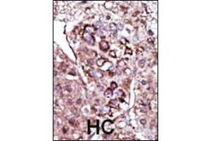 Formalin-fixed and paraffin-embedded human cancer tissue reacted with the primary antibody, which was peroxidase-conjugated to the secondary antibody, followed by AEC staining. (DGKZ antibody  (C-Term))