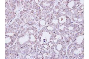 IHC-P Image Immunohistochemical analysis of paraffin-embedded NCI-N87 xenograft, using Transmembrane protein 147, antibody at 1:500 dilution. (TMEM147 antibody)