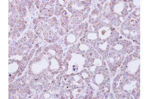 IHC-P Image Immunohistochemical analysis of paraffin-embedded NCI-N87 xenograft, using Transmembrane protein 147, antibody at 1:500 dilution. (TMEM147 antibody)