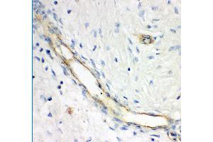 Anti- GCLC antibody, IHC(P) IHC(P): Human Mammary Cancer Tissue