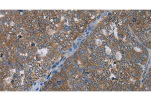 Immunohistochemistry of paraffin-embedded Human ovarian cancer using GABRB1 Polyclonal Antibody at dilution of 1:50 (GABRB1 antibody)