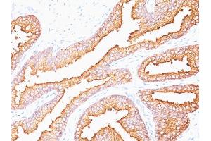 Formalin-fixed, paraffin-embedded human Prostate Carcinoma stained with PSA Monoclonal Antibody (SPM352). (Prostate Specific Antigen antibody)