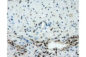Immunohistochemical staining of paraffin-embedded prostate tissue using anti-HK2mouse monoclonal antibody.