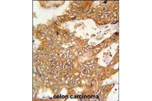 FBXO34 Antibody (C-term) (ABIN651879 and ABIN2840436) immunohistochemistry analysis in formalin fixed and paraffin embedded human colon carcinoma followed by peroxidase conjugation of the secondary antibody and DAB staining. (FBXO34 antibody  (C-Term))