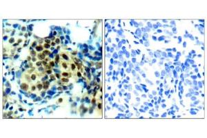 Immunohistochemical analysis of paraffin-embedded human breast carcinoma tissue using p44/42 MAP Kinase (phospho-Thr202) antibody (E011245). (ERK1/2 antibody  (pThr202))