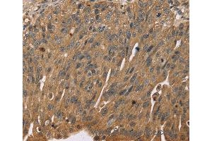 Immunohistochemistry of Human breast cancer using SCGB2A1 Polyclonal Antibody at dilution of 1:50