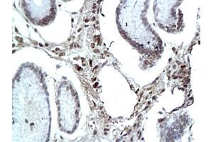 Formalin-fixed and paraffin embedded human colon labeled with Rabbit Anti eIF3F Polyclonal Antibody, Unconjugated (ABIN704906) at 1:200 followed by conjugation to the secondary antibody and DAB staining (e3F (AA 112-210) antibody)