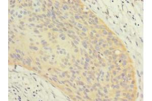 Immunohistochemistry of paraffin-embedded human cervical cancer using ABIN7162366 at dilution of 1:100