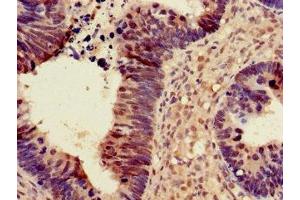 Immunohistochemistry of paraffin-embedded human ovarian cancer using ABIN7169756 at dilution of 1:100