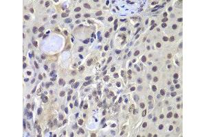 Immunohistochemistry of paraffin-embedded Human well-differentiated squamous skin carcinoma using PRKDC Polyclonal Antibody at dilution of 1:100 (40x lens).
