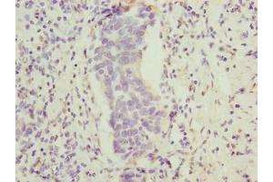 Immunohistochemistry of paraffin-embedded human bladder cancer using ABIN7165470 at dilution of 1:100 (FAM222B antibody  (AA 351-562))