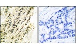 Immunohistochemistry analysis of paraffin-embedded human breast carcinoma tissue, using SRF (Ab-99) Antibody. (SRF antibody  (AA 71-120))