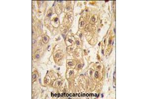 Formalin-fixed and paraffin-embedded human hepatocarcinoma tissue reacted with PDGFRB antibody , which was peroxidase-conjugated to the secondary antibody, followed by DAB staining.