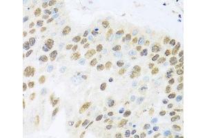 Immunohistochemistry of paraffin-embedded Human lung cancer using ZBTB17 Polyclonal Antibody at dilution of 1:100 (40x lens). (ZBTB17 antibody)