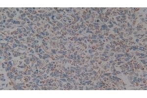 Detection of C1QBP in Human Lung cancer Tissue using Polyclonal Antibody to Complement component 1 Q subcomponent-binding protein, mitochondrial (C1QBP) (C1QBP antibody  (AA 76-282))