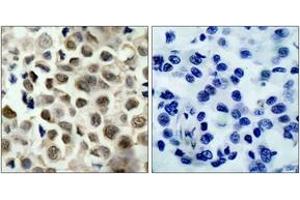 Immunohistochemistry analysis of paraffin-embedded human lung carcinoma, using HDAC8 (Phospho-Ser39) Antibody. (HDAC8 antibody  (pSer39))