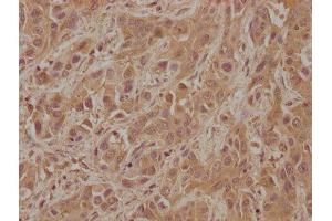 IHC image of ABIN7152833 diluted at 1:100 and staining in paraffin-embedded human liver cancer performed on a Leica BondTM system. (FGFR2 antibody  (AA 577-821))