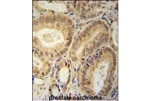 RBM24 Antibody (N-term) (ABIN651797 and ABIN2840402) immunohistochemistry analysis in formalin fixed and paraffin embedded human prostate carcinoma followed by peroxidase conjugation of the secondary antibody and DAB staining. (RBM24 antibody  (N-Term))