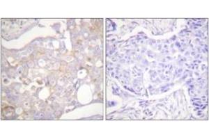 Immunohistochemistry analysis of paraffin-embedded human breast carcinoma tissue, using Claudin 4 Antibody. (Claudin 4 antibody  (AA 160-209))