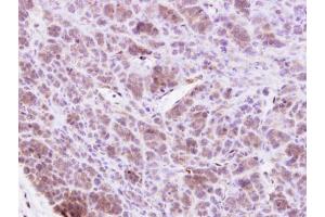 IHC-P Image MAP4K1 antibody [N1], N-term detects MAP4K1 protein at cytosol on BT438 xenograft by immunohistochemical analysis. (MAP4K1 antibody  (N-Term))