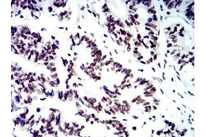 Immunohistochemical analysis of paraffin-embedded rectum cancer tissues using SMARCA1 mouse mAb with DAB staining.