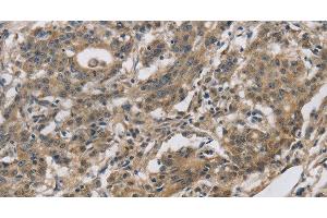 Immunohistochemistry of paraffin-embedded Human gastic cancer using DHRS3 Polyclonal Antibody at dilution of 1:30 (DHRS3 antibody)
