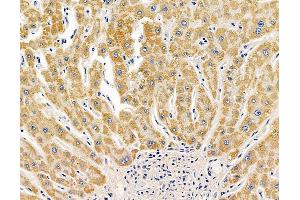 ABIN7095071 and ABIN7099127 at 1/100 staining human liver cancer by IHC-P. (TTPA antibody)