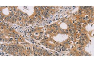 Immunohistochemistry of paraffin-embedded Human gastric cancer using CDK11B Polyclonal Antibody at dilution of 1:40 (CDK11 antibody)