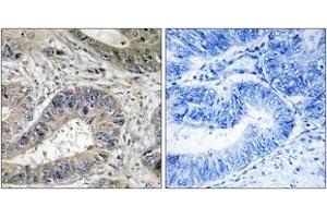 Immunohistochemistry analysis of paraffin-embedded human colon carcinoma tissue, using ERN2 Antibody.