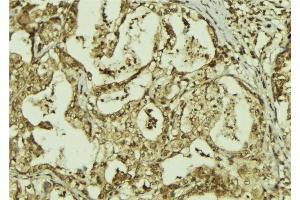 ABIN6273306 at 1/100 staining Human breast cancer tissue by IHC-P. (RBBP9 antibody  (Internal Region))