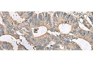Immunohistochemistry of paraffin-embedded Human colorectal cancer tissue using MRPL42 Polyclonal Antibody at dilution of 1:65(x200) (MRPL42 antibody)