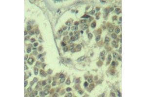 Immunohistochemistry of paraffin-embedded human breast carcinoma using Phospho-eIF2α-S49 antibody (ABIN2987986). (EIF2S1 antibody  (pSer49))