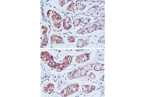 Immunohistochemical analysis of paraffin-embedded human stomach carcinoma tissue using PGA5 monoclonal antobody, clone 2C1  with DAB staining.
