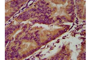 IHC image of ABIN7166221 diluted at 1:200 and staining in paraffin-embedded human endometrial cancer performed on a Leica BondTM system. (IGSF9 antibody  (AA 132-298))