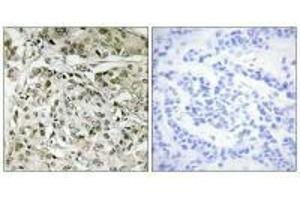 Immunohistochemistry analysis of paraffin-embedded human breast carcinoma tissue, using TAF1 antibody. (TAF1 antibody)