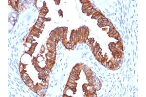 Immunohistochemical staining (Formalin-fixed paraffin-embedded sections) of human endometrial carcinoma with KRT7 recombinant monoclonal antibody, clone rOV-TL12/30 . (Recombinant Cytokeratin 7 antibody)
