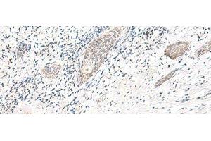 Immunohistochemistry of paraffin-embedded Human esophagus cancer tissue using ARL2BP Polyclonal Antibody at dilution of 1:50(x200) (ARL2BP antibody)