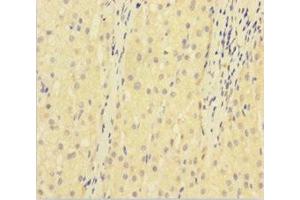 Immunohistochemistry of paraffin-embedded human liver cancer using ABIN7175384 at dilution of 1:100 (VEGFR2/CD309 antibody  (AA 20-764))