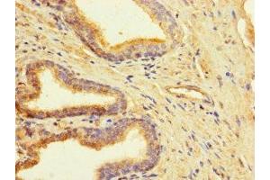 Immunohistochemistry of paraffin-embedded human prostate cancer using ABIN7147948 at dilution of 1:100