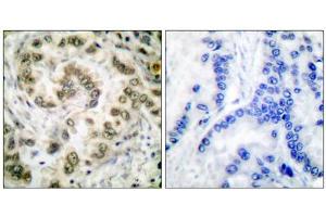 Immunohistochemical analysis of paraffin-embedded human lung carcinoma tissue, using E2F4 antibody (ABIN5976385). (E2F4 antibody  (Internal Region))
