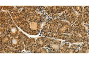 Immunohistochemistry of paraffin-embedded Human thyroid cancer tissue using SOCS5 Polyclonal Antibody at dilution 1:35 (SOCS5 antibody)
