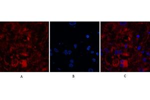 Immunofluorescence analysis of human breast cancer tissue. (Caspase 8 antibody  (Cleaved-Asp384))