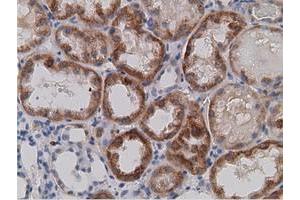 Immunohistochemical staining of paraffin-embedded Carcinoma of Human kidney tissue using anti-SDR9C7 mouse monoclonal antibody. (SDR9C7 antibody)