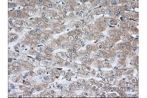 Immunohistochemical staining of paraffin-embedded Carcinoma of Human thyroid tissue using anti-TBXAS1 mouse monoclonal antibody. (TBXAS1 antibody)